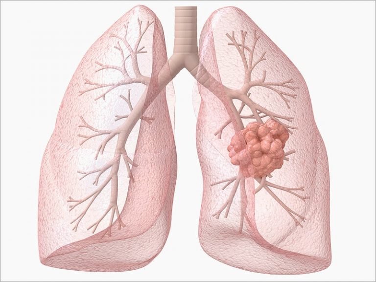 Câncer de Pulmão O que é Causas e Tratamentos Dicas de Musculação