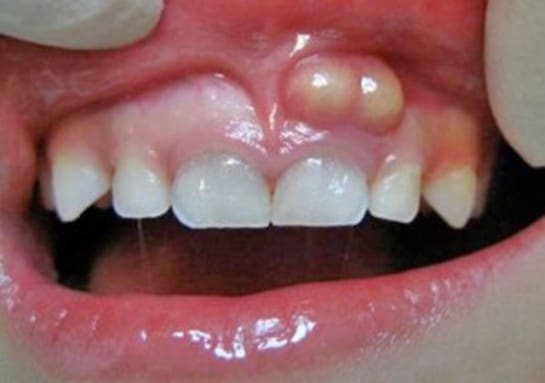 Abscesso Dental