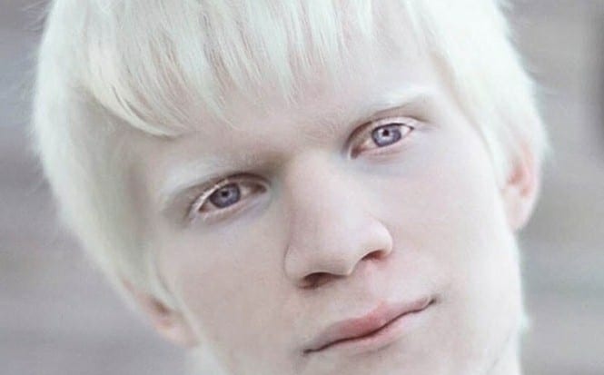 Principais Sintomas de Albinismo