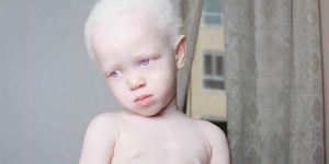 Albinismo Albinismo
