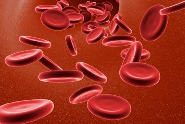 Anemia Hemolítica 1