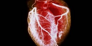 Cardiomiopatia