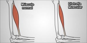 Distrofia Muscular distrofia muscular
