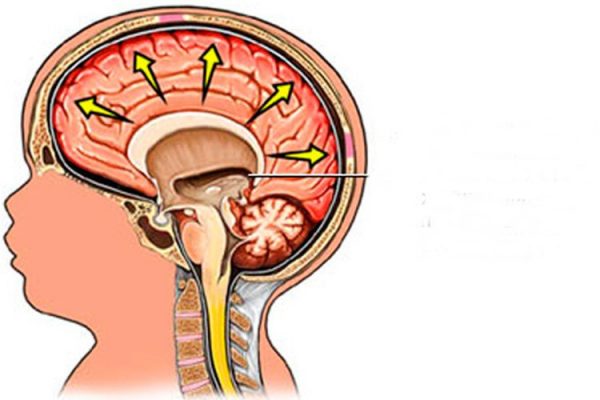 Hidrocefalia O Que é Causas Sintomas E Tratamentos Dicas De Musculação 8351