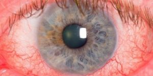Rosácea Ocular 1 1