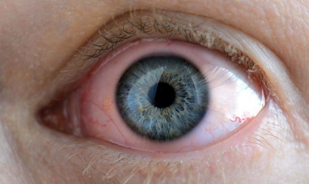 Principais Tratamento Para Rosácea Ocular