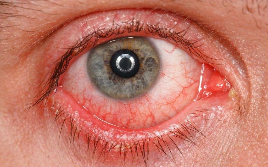 Principais Tratamento Para Rosacea Ocular