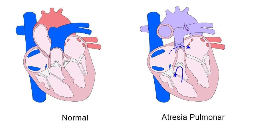 atresia pulmonar