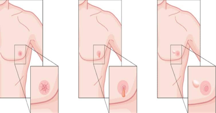 câncer de mama em homens