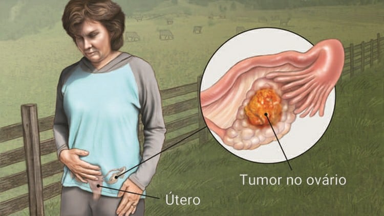 Principais Sintomas do Câncer de Ovário