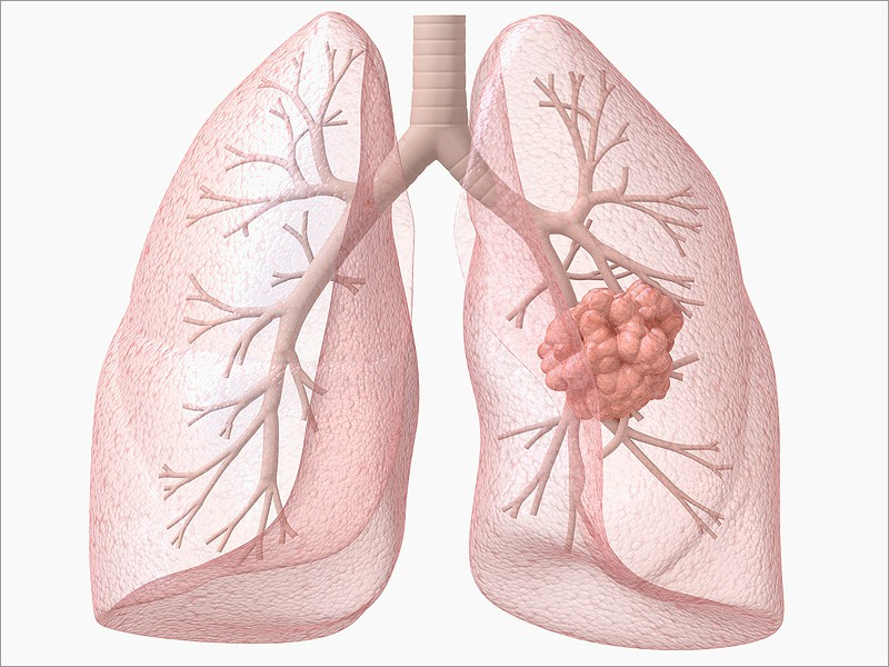 câncer de pulmão 2