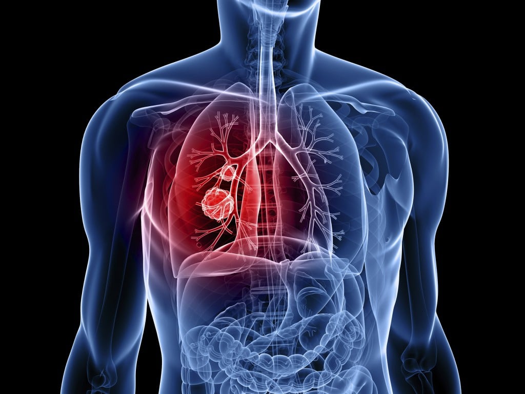 câncer de pulmão