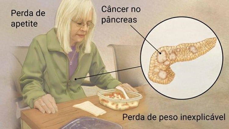 Principais Sintomas de Câncer de Pâncreas