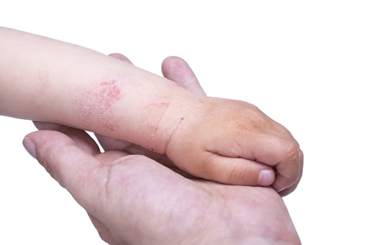 Principais Sintomas da Dermatite