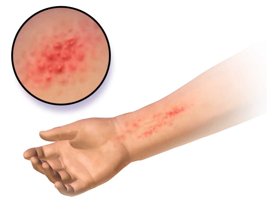 Eczema Atópico