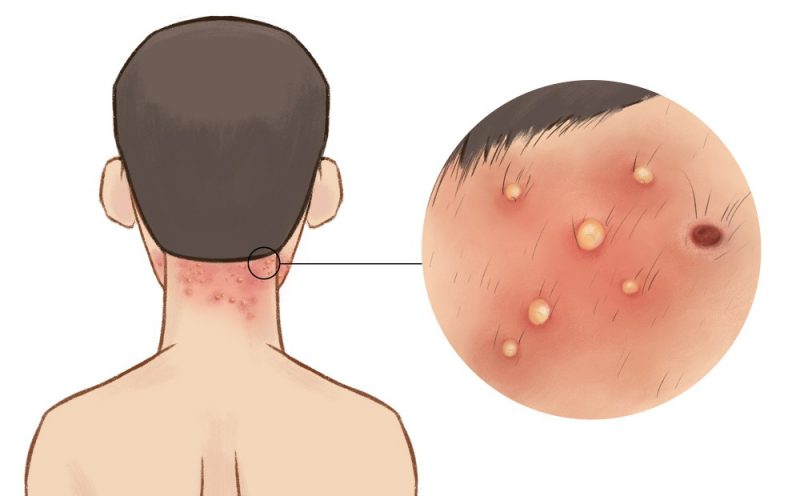 Foliculite O Que Causas Sintomas E Tratamento Dicas De Muscula O