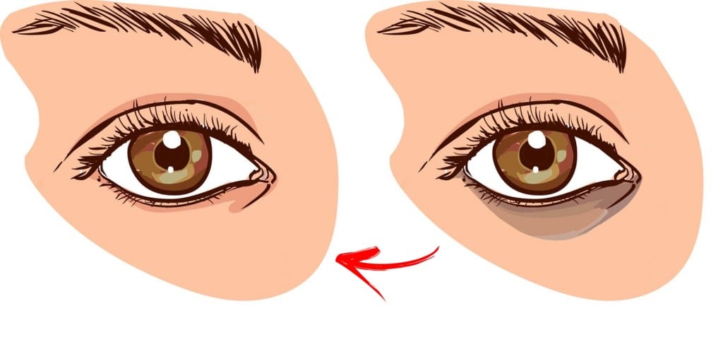 como eliminar os círculos escuros sob os olhos