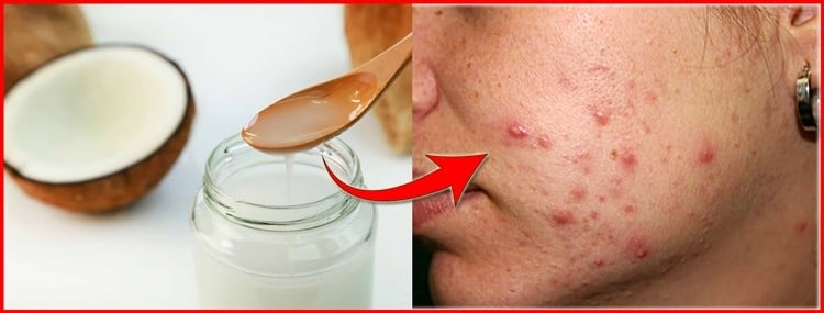 como tratar a acne de forma simples