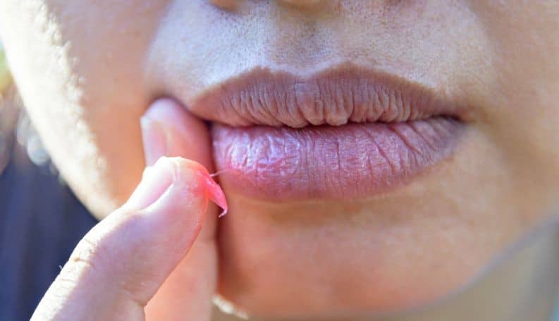 Remédios Caseiros Para Tratar Lábios Rachados