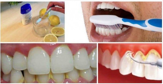 como eliminar o tártaro, placas e sangramento do dentes